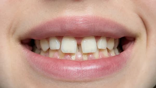 Thumbnail — Ceramic Veneers