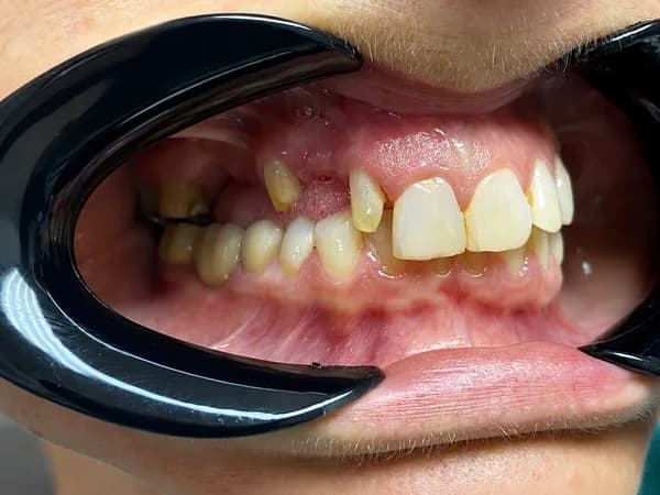 Thumbnail — Metal-Free Ceramic Bridge