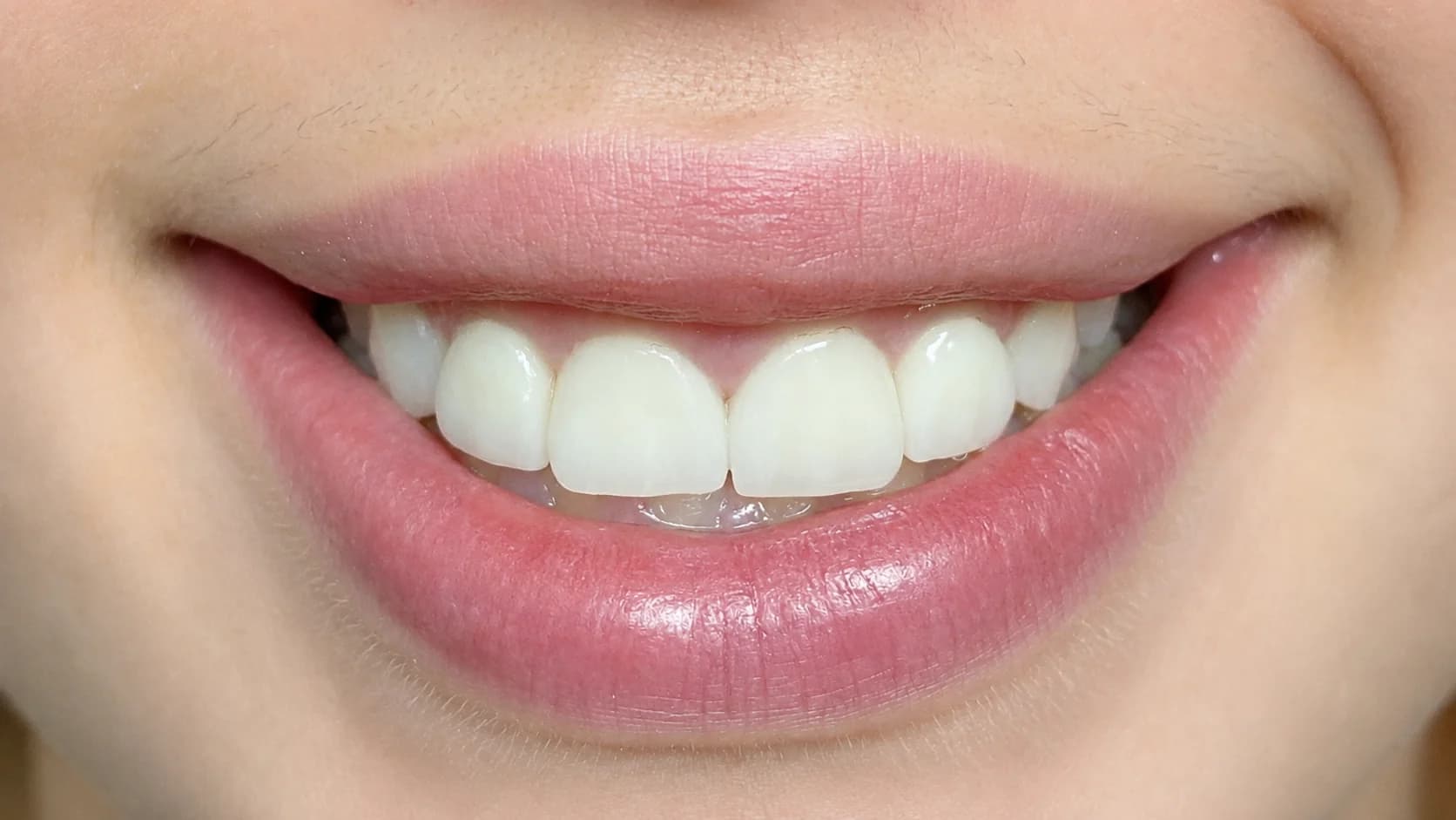 AFTER — Ceramic Veneers
