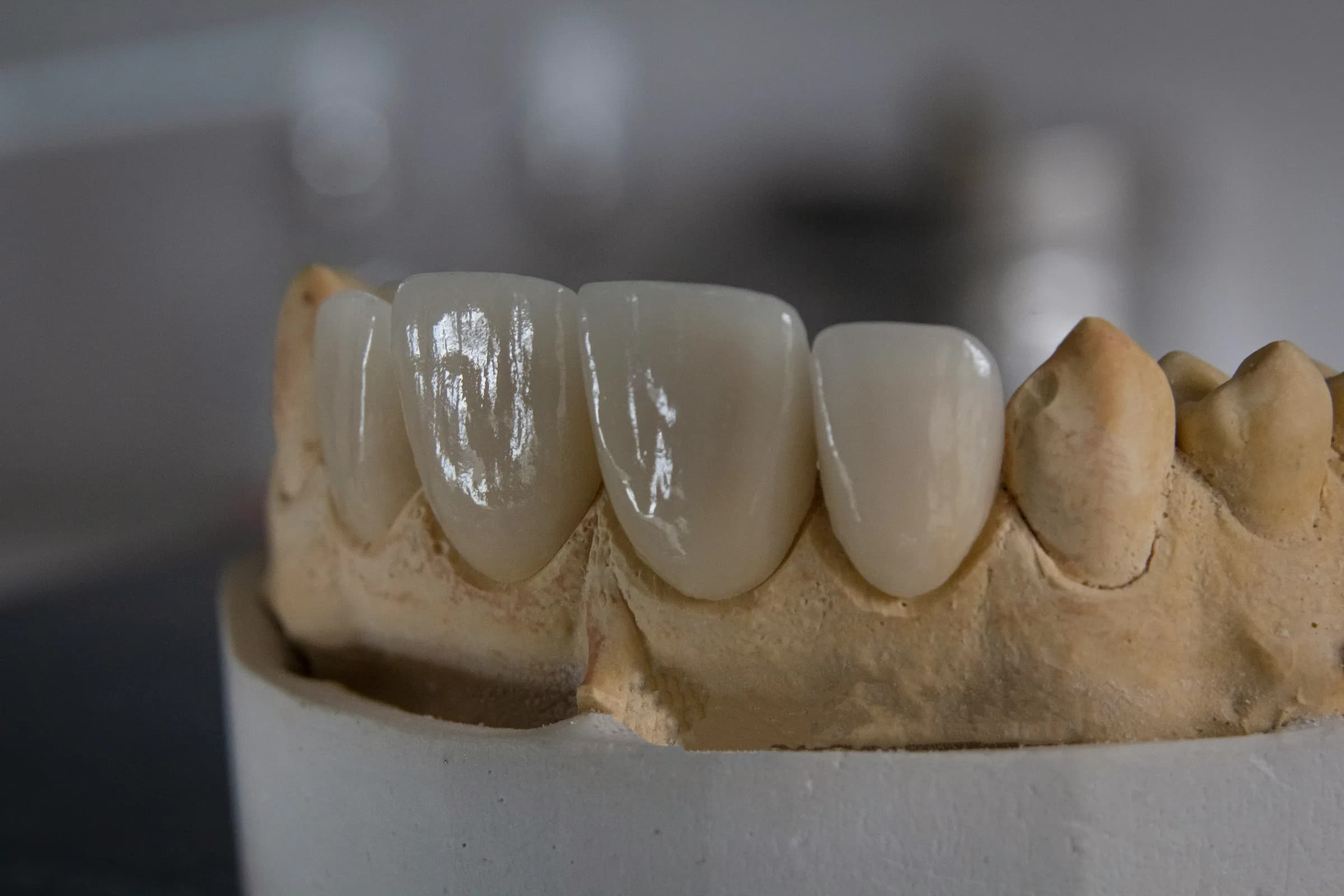 Crowns & Prosthodontics